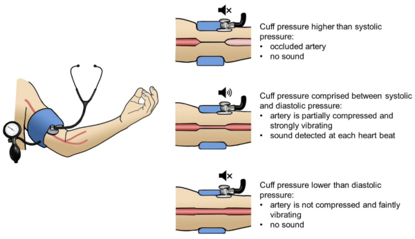 Principle of a blood pressure measurement using an inflatable cuff.